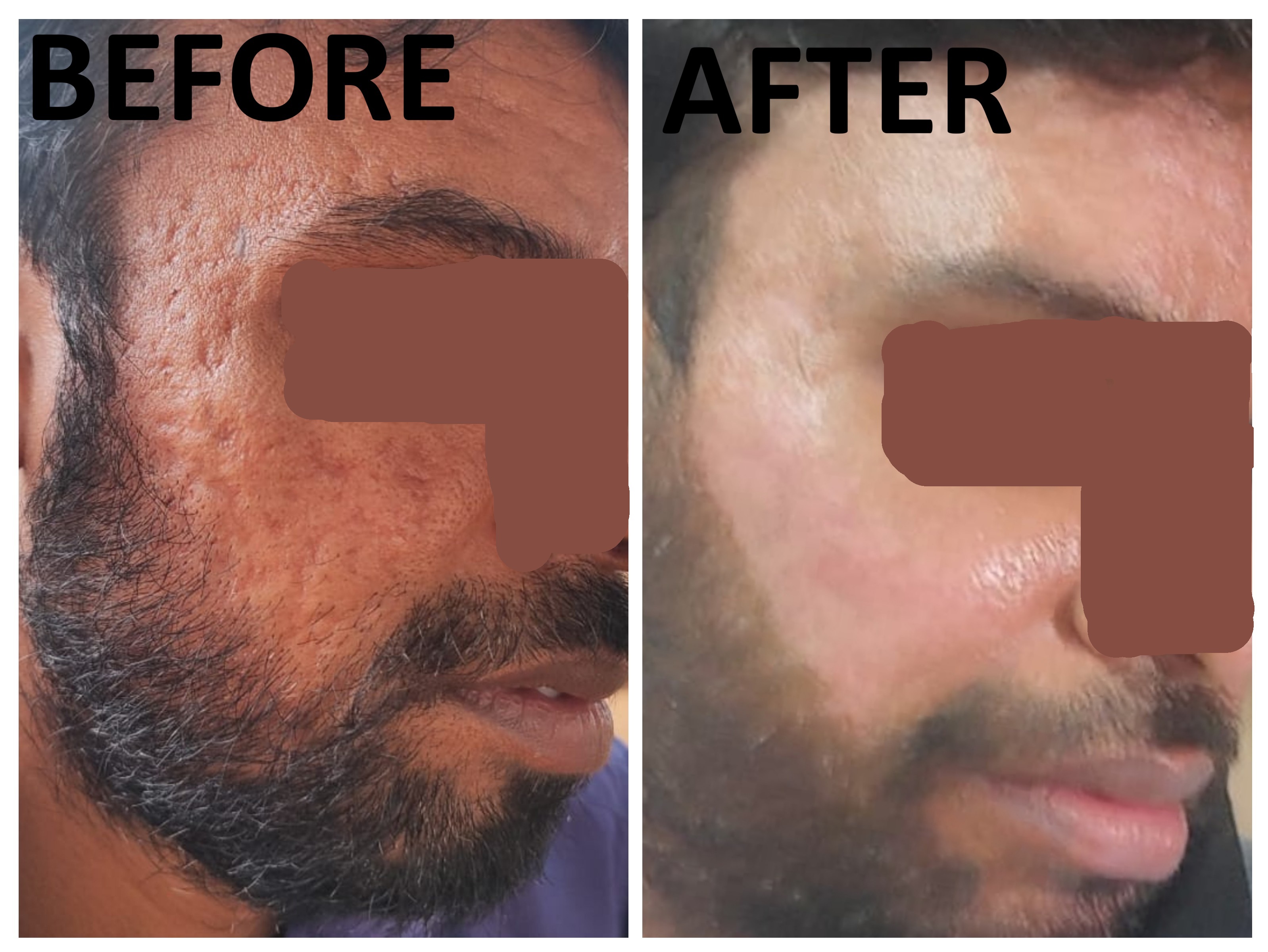 Lipoma